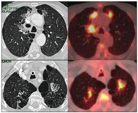 PET/CT en cáncer pulmonar