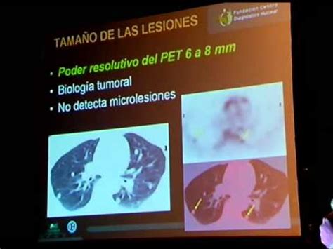 PET CT  Tomografía por Emisión de Positrones  | Doovi