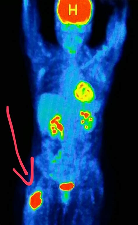 PET scan shows a malignant tumor  cancer  in the hip ...