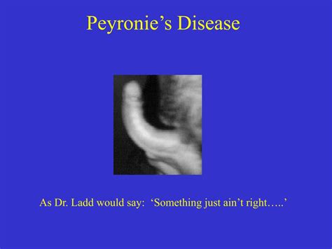 Peyronies Disease | www.imgkid.com   The Image Kid Has It!