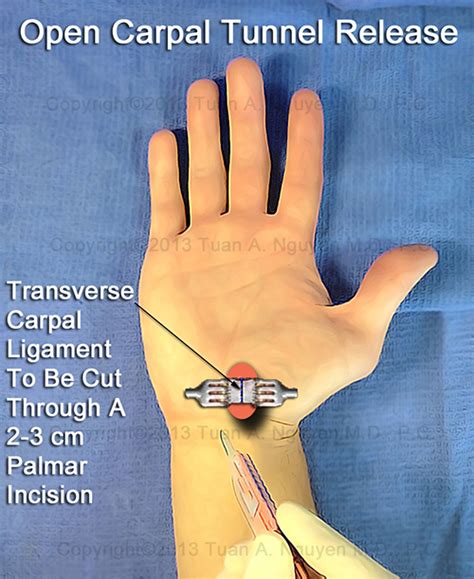 Pics For > Open Carpal Tunnel Surgery