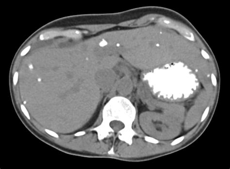 Picture: Medullary Thyroid Carcinoma metastatic to Liver ...