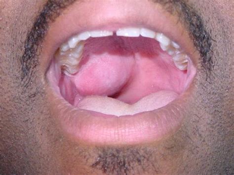 Picture of Pleomorphic Adenoma of the Palate ...