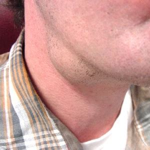 Picture of Submandibular Pleomorphic Adenoma  Benign Mixed ...