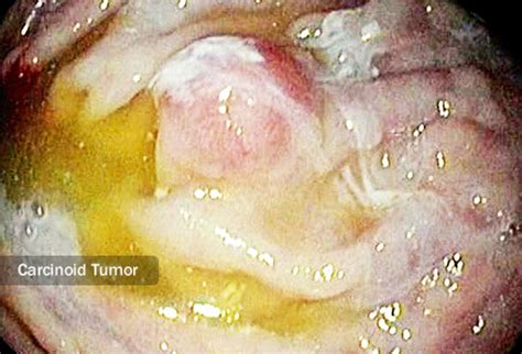 Pictures: Guide to Stomach Cancer