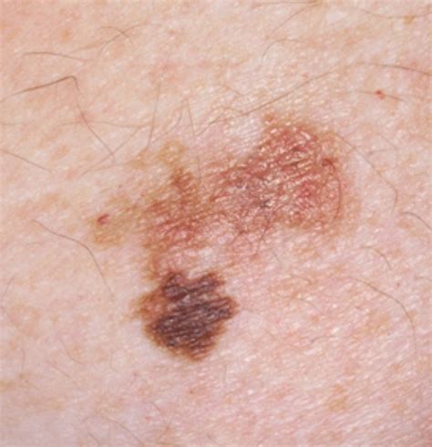 Pictures of skin cancer: Age spots or skin cancer