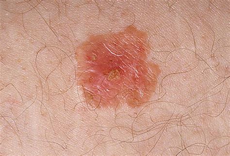 Pictures of skin cancer: Skin cancer white spots