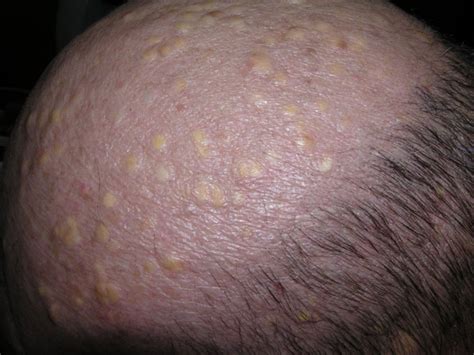 pilar cysts on head   pictures, photos