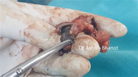 Pilonidal Cyst With Pilonidal Sinus with Hair   YouTube