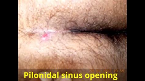 Pilonidal sinus permanent cure without surgery   YouTube