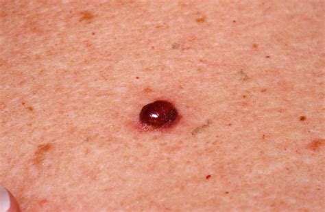 Pin Amelanotic malignant melanoma treatment sifrixorg on ...