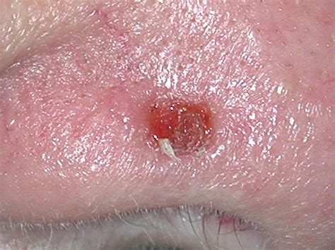 Pin Skin Cancer Squamous Cell Pictures on Pinterest