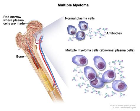 Plasma Cell Neoplasms  Including Multiple Myeloma ...