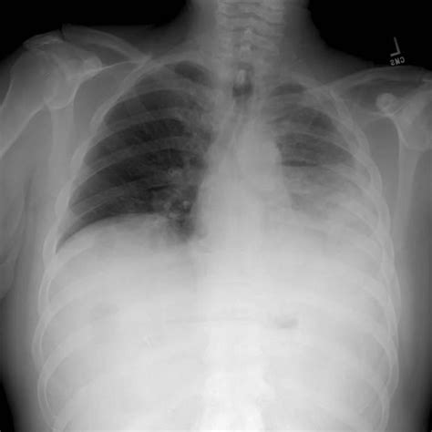 Pleural Effusion   Lung and Airway Disorders   Merck ...