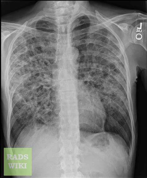 Pneumocystis carinii pneumonia | Image | Radiopaedia.org