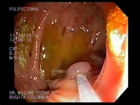 Polipectomia dificil de Pólipo en colon ascendente   YouTube