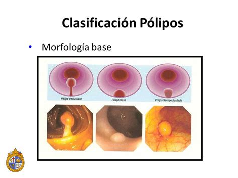Polipectomía y biopsias Dra. Paula Rey/ Dr. Allan Sharp ...