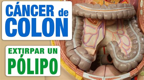 Pólipo en Colon   ¿Cómo se extirpa?   YouTube