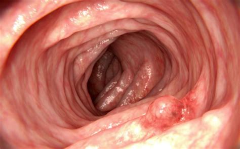 Pólipos en el colon ¿son peligrosos? Síntomas y tratamiento