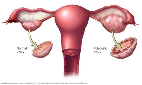 Polycystic Ovary Syndrome   symptoms, causes and complications