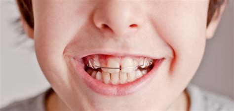 Por que algumas crianças têm os dentes separados