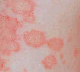 ¿Por qué salen manchas rojas en la piel? 5 posibles causas ...