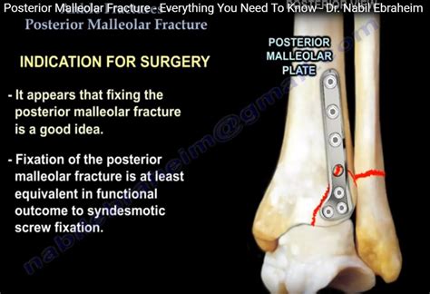 Posterior Malleolar Ankle Fracture — OrthopaedicPrinciples.com