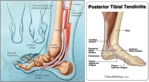 Posterior Tibial Tendon Dysfunction   Somastruct | Healthy ...