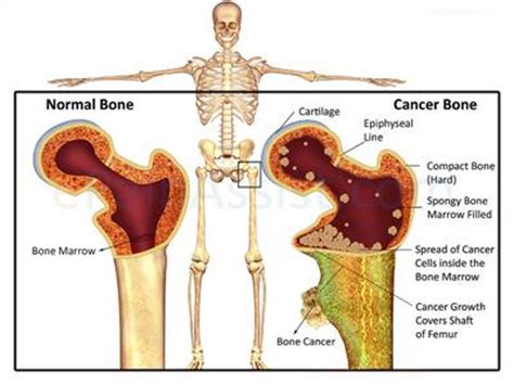 Powerful Natural Cure for Bone Metastases  Bone Cancer ...