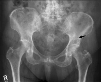 Pre procedure plain X ray of pelvis shows a lytic lesio ...