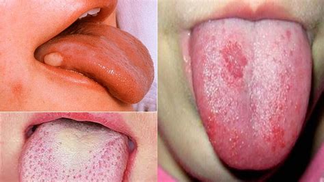 Primeros síntomas de cáncer de lengua   YouTube