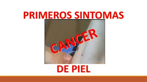 PRIMEROS SINTOMAS DE UN CANCER DE PIEL   YouTube