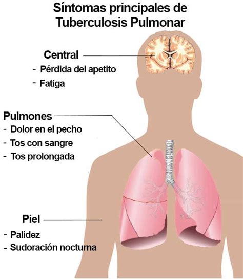 Principales síntomas de Tuberculosis Pulmonar ...