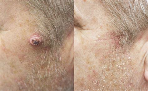 Private Skin Cancer Treatment   Skin Surgery Clinic