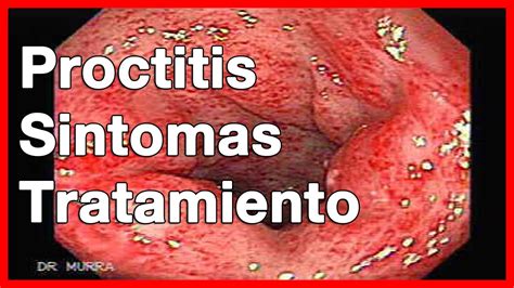 Proctitis o inflamación rectal // Síntomas, causas y ...