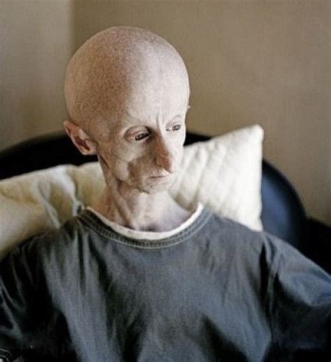 Progeria: An Inspiration: Celebrity with Progeria