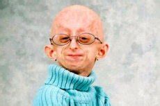 Progeria of adults  Werner s syndrome : causes, symptoms ...