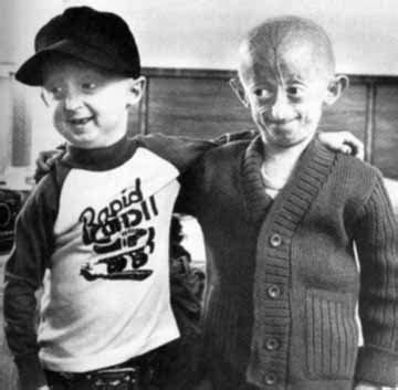 Progeria | Rare Disorders
