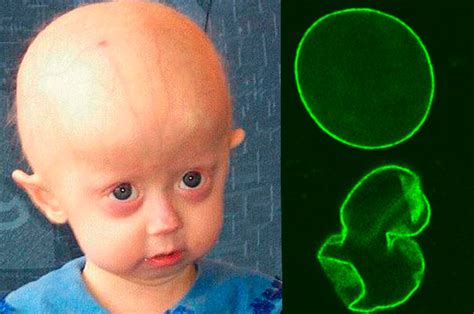 Progeria: Tipos, Causas, Tratamientos   Lifeder