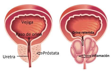 Próstata inflamada: síntomas, causas y tratamiento ...