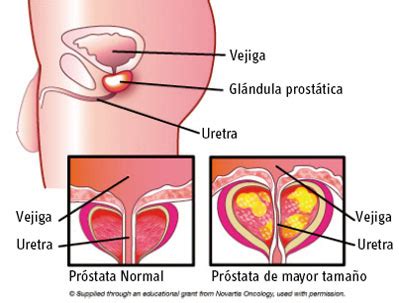 Próstata Inflamada: Síntomas, Causas y Tratamiento ...