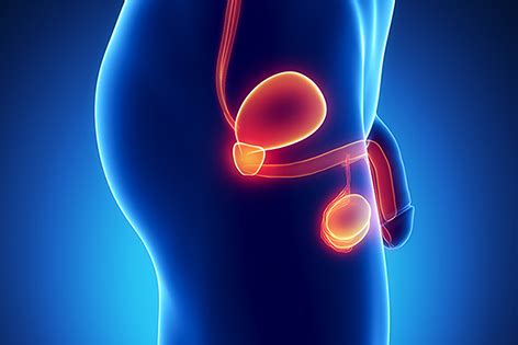 Próstata Inflamada: Síntomas, Causas y Tratamiento ...