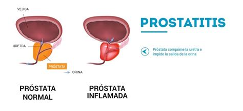 Próstata Inflamada | Tipos de Próstata Inflamada y sus ...