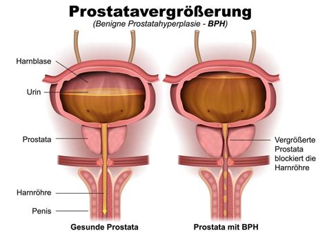 Prostata  Vorsteherdrüse    Männliches Geschlechtsorgan ...