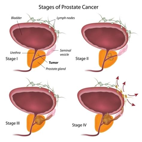 Prostate cancer   Genetics Home Reference