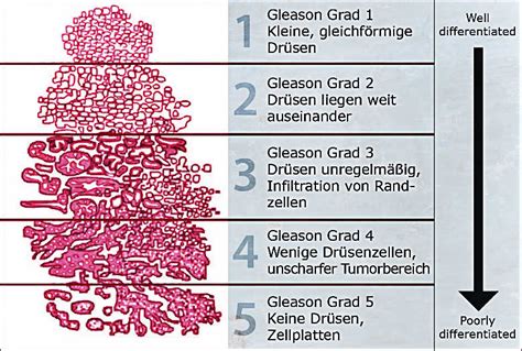 Prostate Cancer Gleason Score