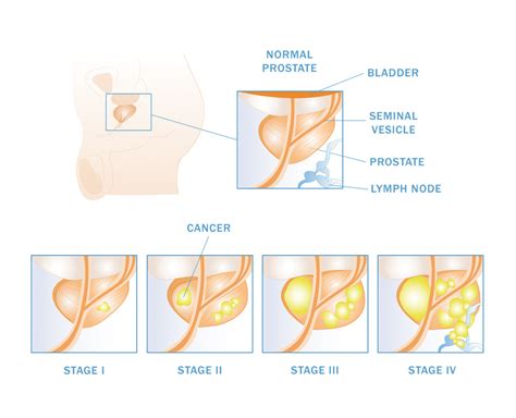 Prostate Cancer Los Angeles | Expert Urologists ...