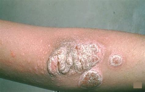 Psoriasis   Appearance, Causes, Types, Symptoms, Treatment ...