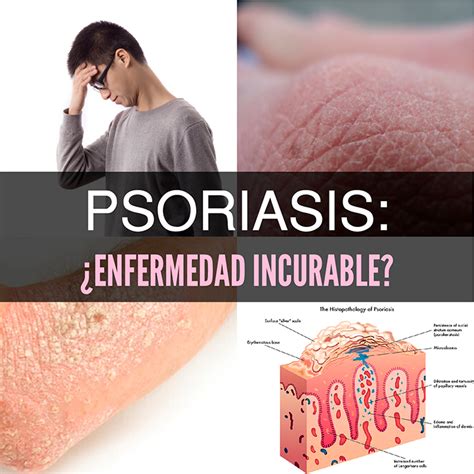 Psoriasis: Qué Es, Causas, Síntomas Y Tratamiento   La ...