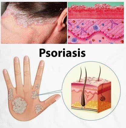 Psoriasis: síntomas, causas, tratamientos, diagnósticos y más